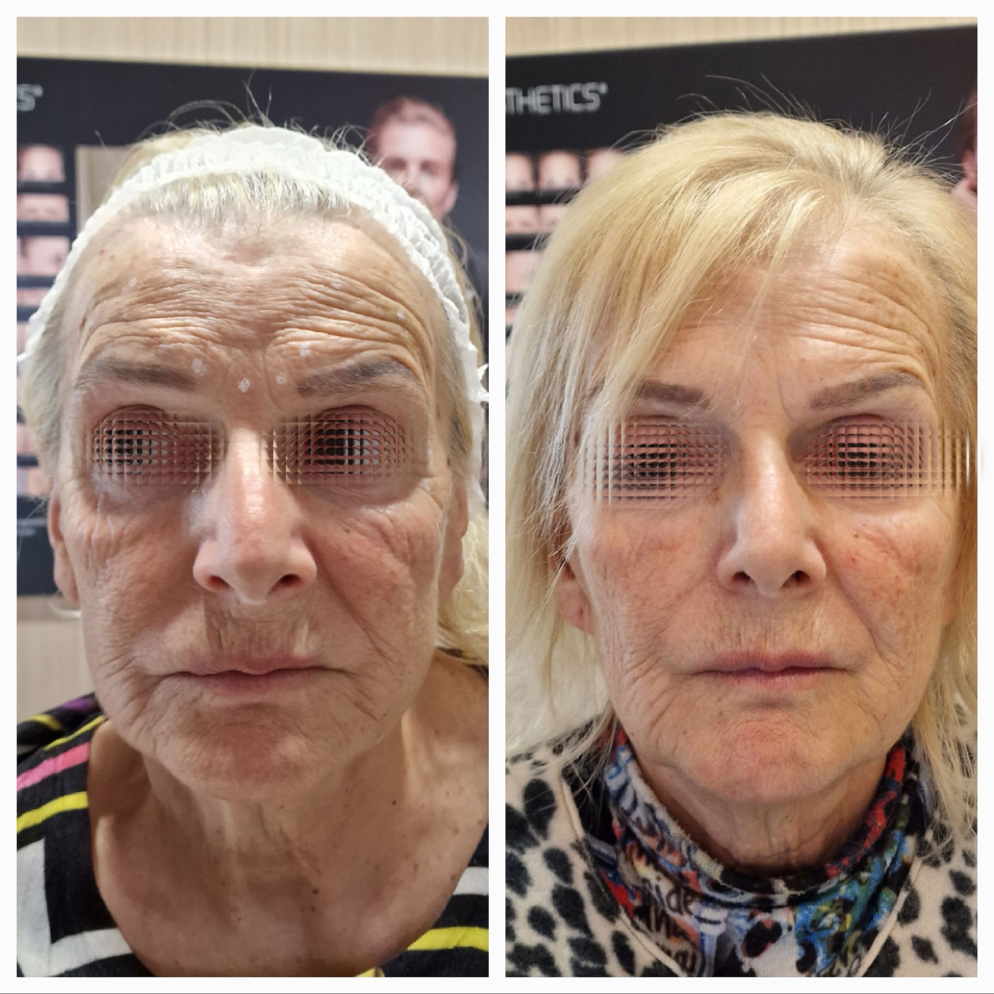 Rejuvenescimento Avançado